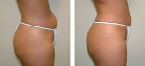 Velashape III Body Contouring and Cellulite Treatment at Beauty Within Medi  Spa